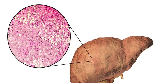 Karaciğer Yağlanması Belirtileri Nelerdir? Karaciğer Yağlanması Nasıl Anlaşılır, Tedavisi Nasıl Yapılır?