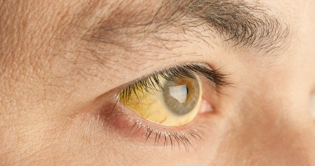 Bilirubin Nedir? Bilirubin Yüksekliği ve Düşüklüğü Ne Anlama Gelir, Normal Değerleri ve Referans Aralığı Nedir?