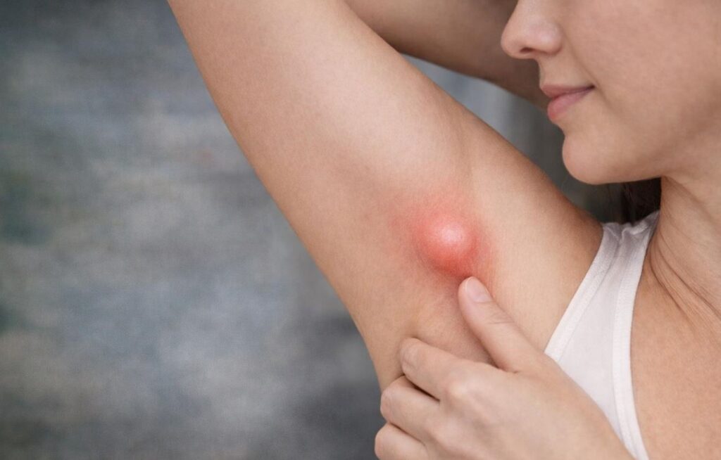 Koltuk Altındaki Şişlik Her Zaman Masum Değil: Ektopik Meme Dokusu Uyarısı